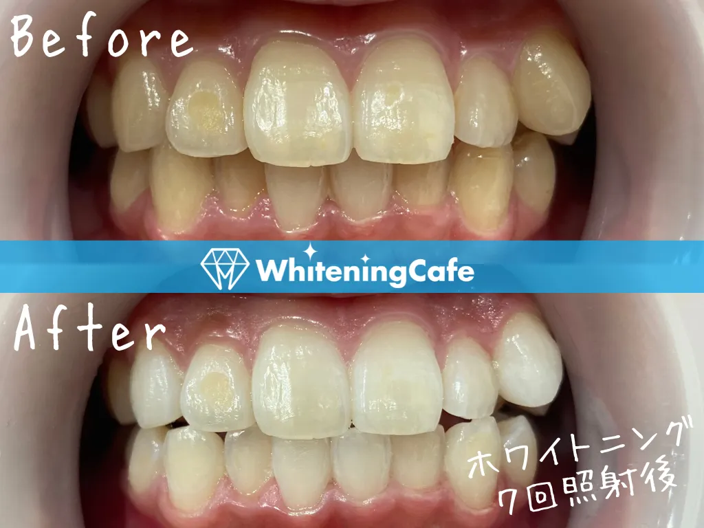 施術前後の様子'3例目'