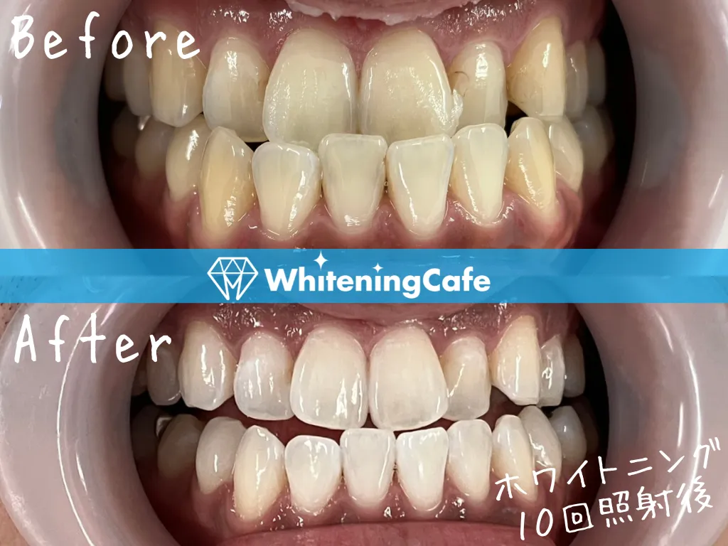 施術前後の様子'20例目'