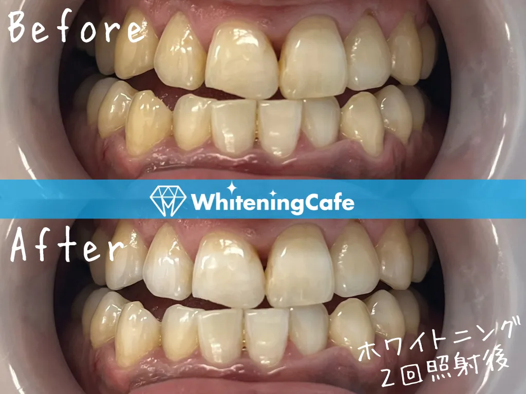 施術前後の様子'23例目'