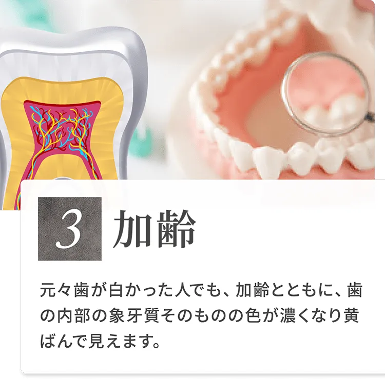 3）加齢 元々歯が白かった人でも、加齢とともに、歯の内部の象牙質そのものの色が濃くなり黄ばんで見えます。