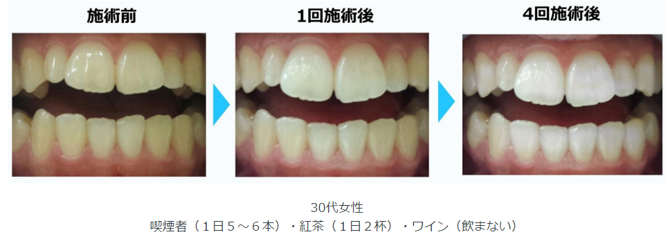 ホワイトニングビフォーアフター