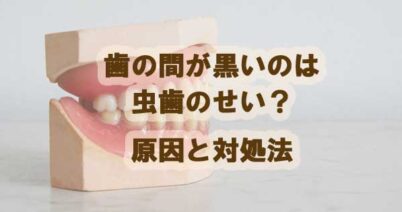 歯の間が黒いのは虫歯のせい？原因と対処法について知ろう