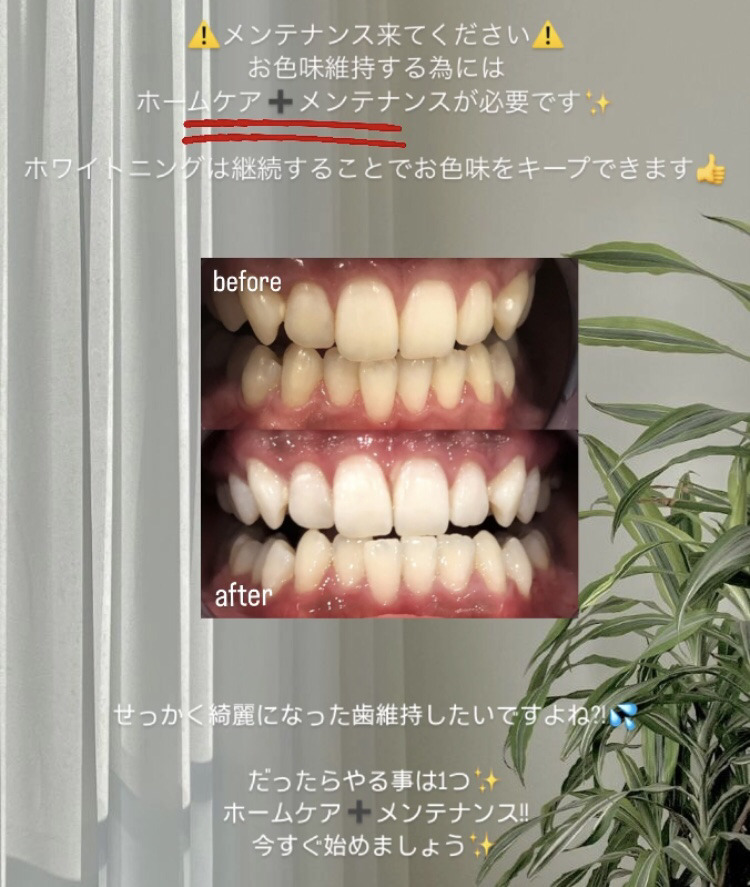定期的なメンテナンスが大切です?? | ホワイトニングカフェで白い歯 